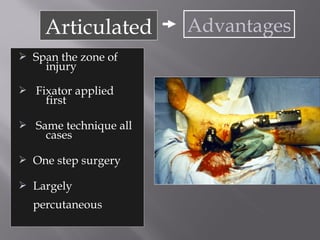 Articulated Advantages 
 Span the zone of 
injury 
 Fixator applied 
first 
 Same technique all 
cases 
 One step surgery 
 Largely 
percutaneous 
 