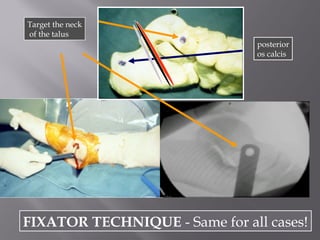 Target the neck 
of the talus 
posterior 
os calcis 
FIXATOR TECHNIQUE - Same for all cases! 
 