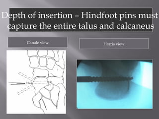 Depth of insertion – Hindfoot pins must 
capture the entire talus and calcaneus 
Canale view Harris view 
 