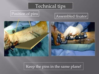 Technical tips 
Position of pins Assembled fixator 
Keep the pins in the same plane! 
 