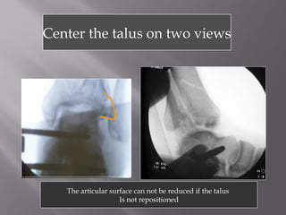 Center the talus on two views 
The articular surface can not be reduced if the talus 
Is not repositioned 
 