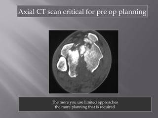 Axial CT scan critical for pre op planning 
The more you use limited approaches 
the more planning that is required 
 
