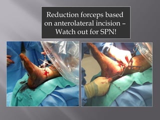 Reduction forceps based 
on anterolateral incision – 
Watch out for SPN! 
 