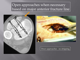Open approaches when necessary 
based on major anterior fracture line 
Direct approaches - no stripping 
 