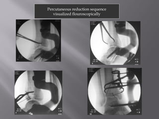 Percutaneous reduction sequence 
visualized flouroscopically 
 