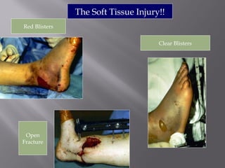 The Soft Tissue Injury!! 
Red Blisters 
Clear Blisters 
Open 
Fracture 
 