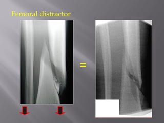 Femoral distractor 
= 
 