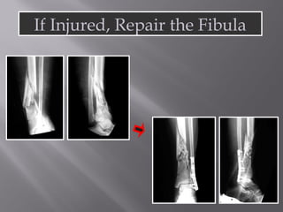 If Injured, Repair the Fibula 
 