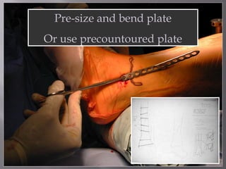 Pre-size and bend plate 
Or use precountoured plate 
 
