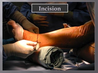 Incision 
 