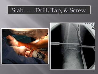 Stab……Drill, Tap,  Screw 
 