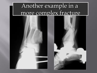 AAnnootthheerr eexxaammppllee iinn aa 
mmoorree ccoommpplleexx ffrraaccttuurree 
 