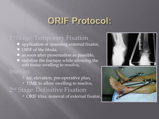 1st Stage: Temporary Fixation 
 application of spanning external fixator, 
 ORIF of the fibula, 
 as soon after presentation as possible, 
 stabilize the fracture while allowing the 
soft tissue swelling to resolve, 
Interim: 
 ice, elevation, pre-operative plan, 
 TIME to allow swelling to resolve, 
2nd Stage: Definitive Fixation 
 ORIF tibia, removal of external fixator, 
 