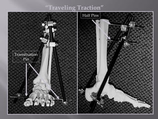 “Traveling Traction” 
Half Pins 
Transfixation 
Pin 
 