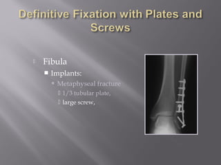  Fibula 
 Implants: 
 Metaphyseal fracture 
 1/3 tubular plate, 
 large screw, 
 