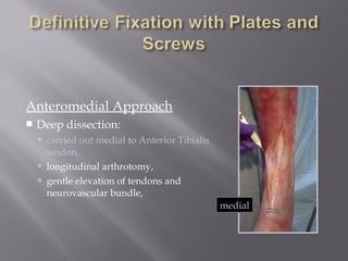 Anteromedial Approach 
 Deep dissection: 
 carried out medial to Anterior Tibialis 
tendon, 
 longitudinal arthrotomy, 
 gentle elevation of tendons and 
neurovascular bundle, 
medial 
 