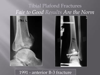 Tibial Plafond Fractures 
Fair to Good Results Are the Norm 
1991 - anterior B-3 fracture 
 