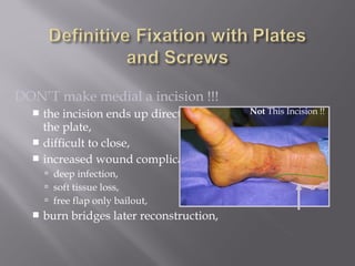 DON’T make medial a incision !!! 
 the incision ends up directly over 
the plate, 
 difficult to close, 
 increased wound complications, 
 deep infection, 
 soft tissue loss, 
 free flap only bailout, 
 burn bridges later reconstruction, 
Not This Incision !! 
 