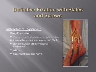 Anterolateral Approach 
 Deep Dissection: 
 through superior and inferior retinaculae, 
 interval between toe extensors and fibula, 
 elevate muscles off interosseous 
membrane, 
 Caution 
 Superficial peroneal nerve 
 