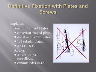 Implants: 
 Small Fragment Plates 
 cloverleaf shaped plate, 
 distal radius “T” plates, 
 1/3 tubular plates, 
 3.5 LC-DCP, 
 Screws 
 3.5 cortical/4.0 
cancellous, 
 cannulated: 4.0/4.5 
 