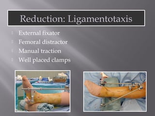 Lecture ucmc pilon plafond fracture distal tibia | PPT