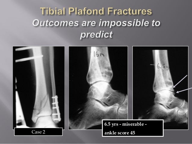 Lecture Ucmc Pilon Plafond Fracture Distal Tibia Lecture Ucmc Pilon Plafond Fracture Distal Tibia