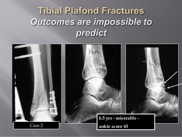 Lecture Ucmc Pilon Plafond Fracture Distal Tibia