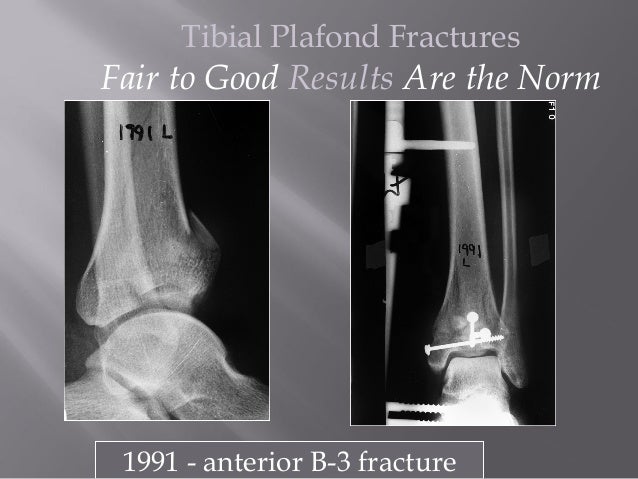 Lecture Ucmc Pilon Plafond Fracture Distal Tibia