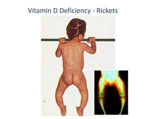 Vitamin D Deficiency - Rickets
 