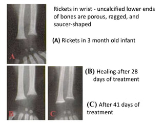 Rickets in wrist - uncalcified lower ends
of bones are porous, ragged, and
saucer-shaped
(A) Rickets in 3 month old infant
(B) Healing after 28
days of treatment
(C) After 41 days of
treatment
A
B C
 