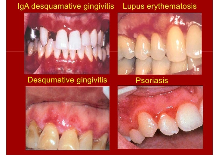Lecture xiii juoral pathologylecture xiiiperio5