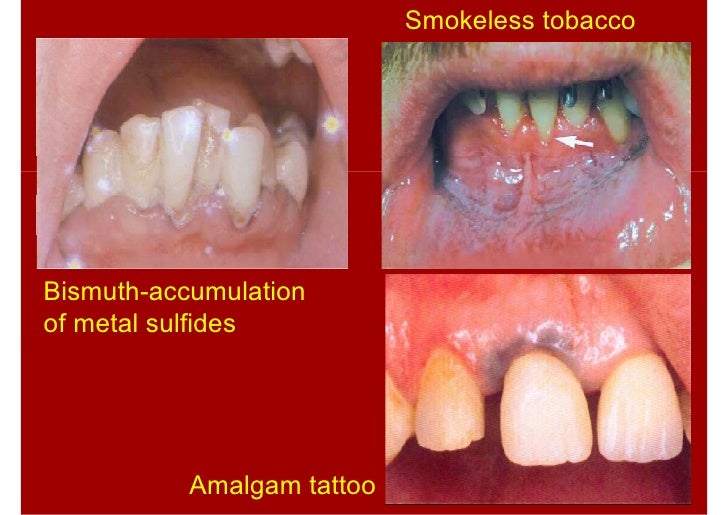 Lecture xiii juoral pathologylecture xiiiperio5