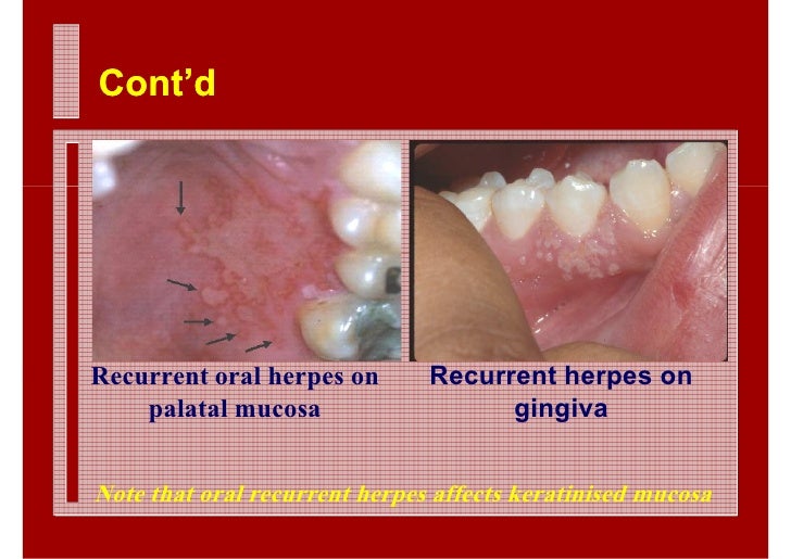 Canker Sore: Overview, Causes, Diagnosis & Pictures