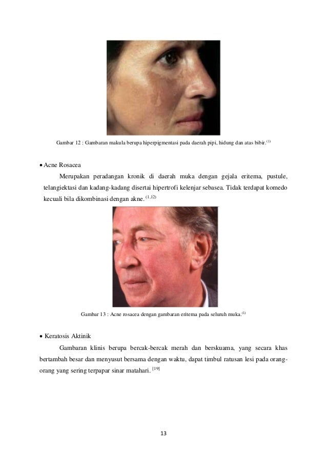 Lupus Eritematous Discoid