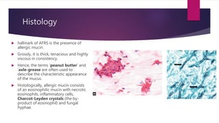 Histology
 hallmark of AFRS is the presence of
allergic mucin.
 Grossly, it is thick, tenacious and highly
viscous in consistency.
 Hence, the terms ‘peanut butter’ and
‘axle-grease are often used to
describe the characteristic appearance
of the mucus.
 Histologically, allergic mucin consists
of an eosinophilic mucin with necrotic
eosinophils, inflammatory cells,
Charcot-Leyden crystals (the by-
product of eosinophil) and fungal
hyphae.
 