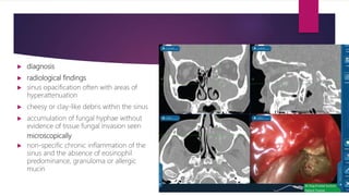  diagnosis
 radiological findings
 sinus opacification often with areas of
hyperattenuation
 cheesy or clay-like debris within the sinus
 accumulation of fungal hyphae without
evidence of tissue fungal invasion seen
microscopically
 non-specific chronic inflammation of the
sinus and the absence of eosinophil
predominance, granuloma or allergic
mucin
 