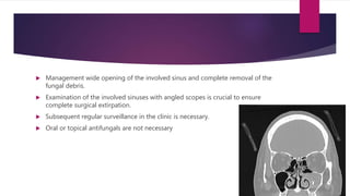  Management wide opening of the involved sinus and complete removal of the
fungal debris.
 Examination of the involved sinuses with angled scopes is crucial to ensure
complete surgical extirpation.
 Subsequent regular surveillance in the clinic is necessary.
 Oral or topical antifungals are not necessary
 