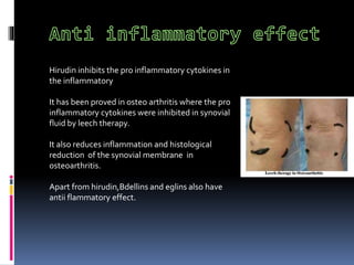 Irsal e Alaq (Leech Therapy)