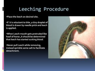 Irsal e Alaq (Leech Therapy)