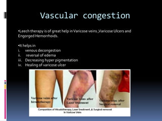 Irsal e Alaq (Leech Therapy)