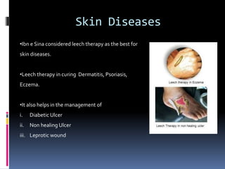 Irsal e Alaq (Leech Therapy)