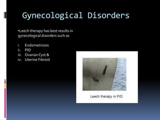 Irsal e Alaq (Leech Therapy)