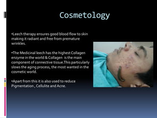 Irsal e Alaq (Leech Therapy)