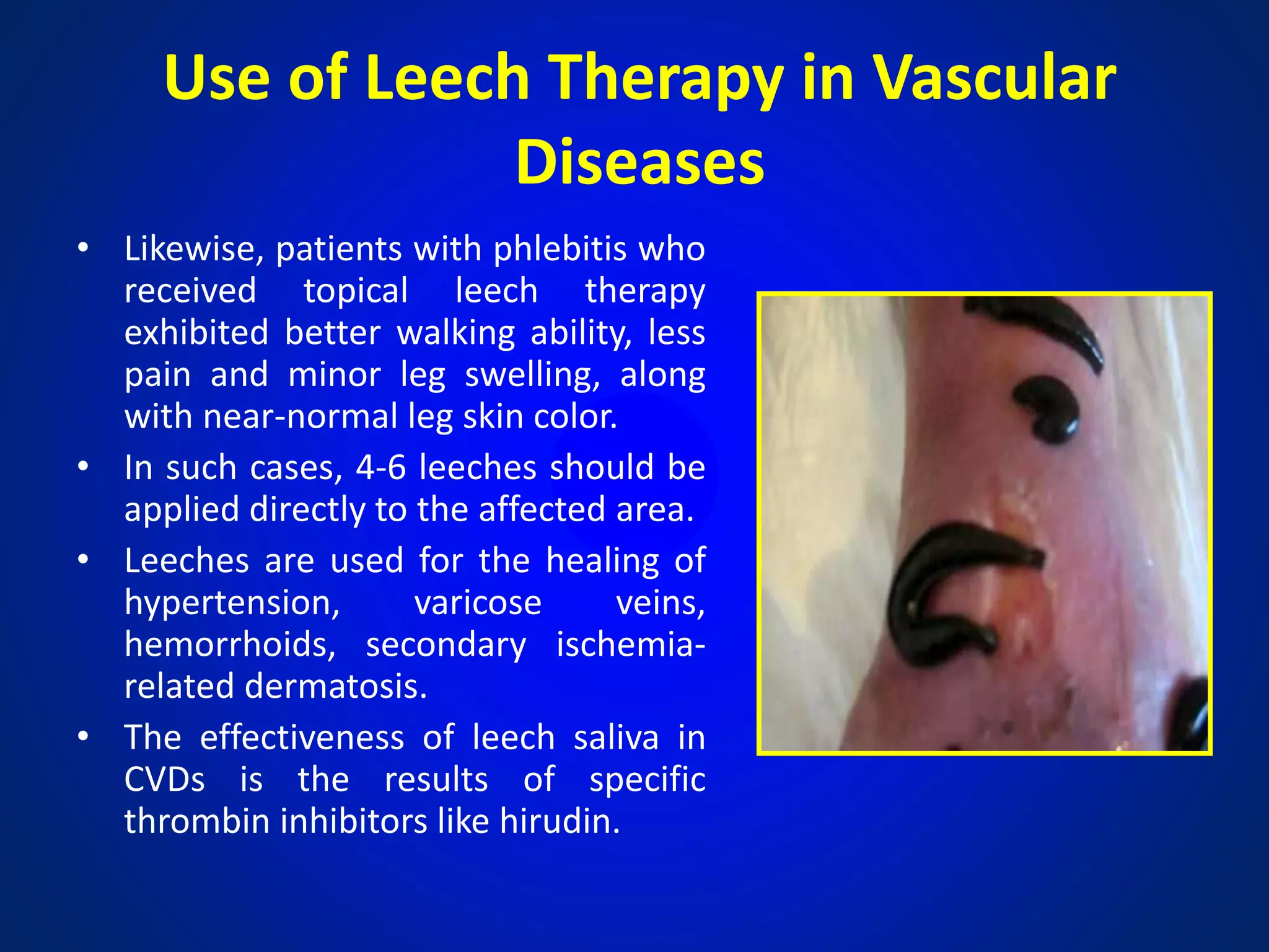 Leech therapy by Dr.M.A.Lateef Siddiqui.