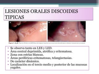 LUPUS ERITEMATOSO PPT lupus-eritematoso-ppt