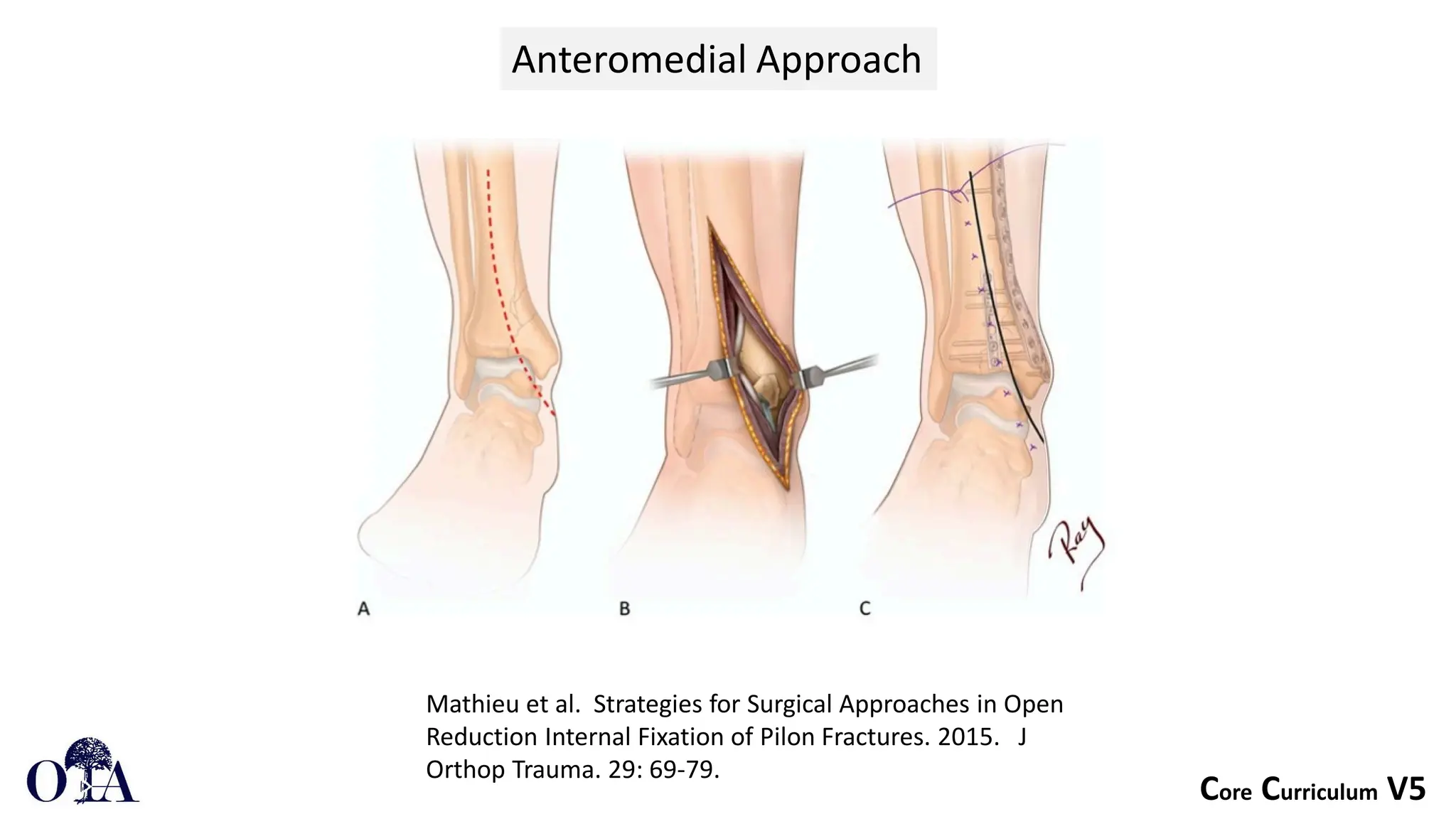 Pilon Fractures definition and classification | PDF