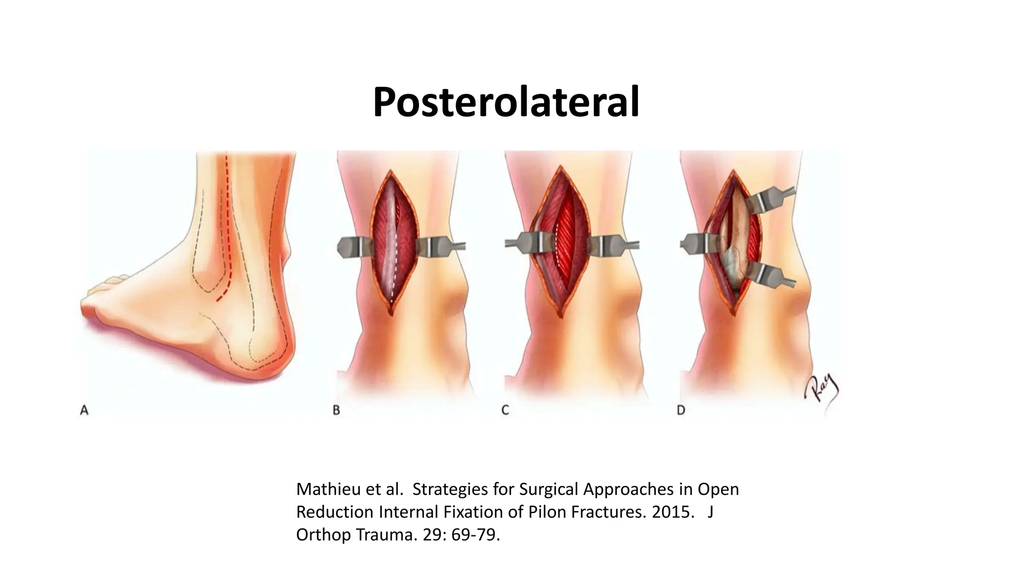 Open Pilon Pilon Fractures definition and classification | PDF