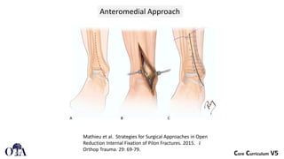 Neuro Pilon Pilon Fractures definition and classification | PDF