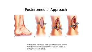 Open Pilon Pilon Fractures definition and classification | PDF