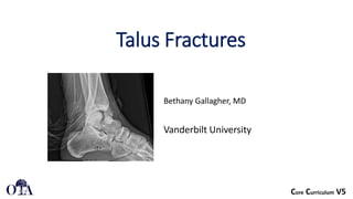 Talus Slides LE F&A4 Fractures and Dislocation of the Talus.pdf